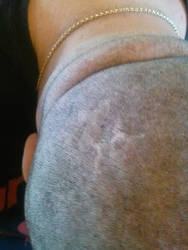 My awesome scar