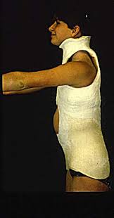 Risser body cast (side) by chebhasni on DeviantArt