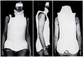 Impressive risser body cast by chebhasni on DeviantArt