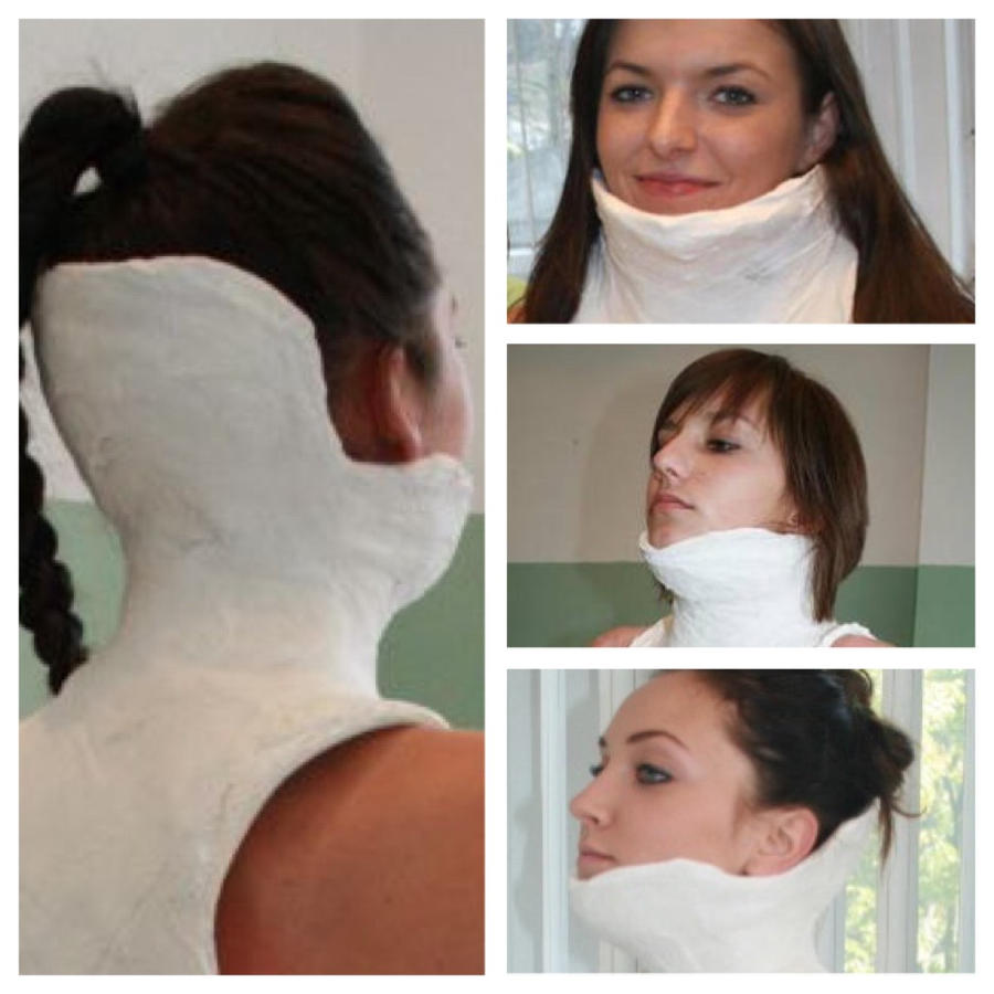 Risser Jacket Cast : Evolution of casting techniques in early-onset and ...