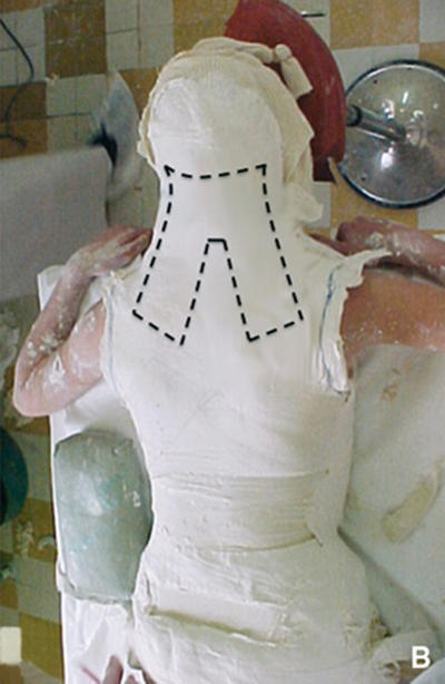 First Body Cast Full body cast before windows opening (back) by chebhasni on DeviantArt
