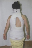 From one cast to another (Risser cast) by chebhasni on DeviantArt