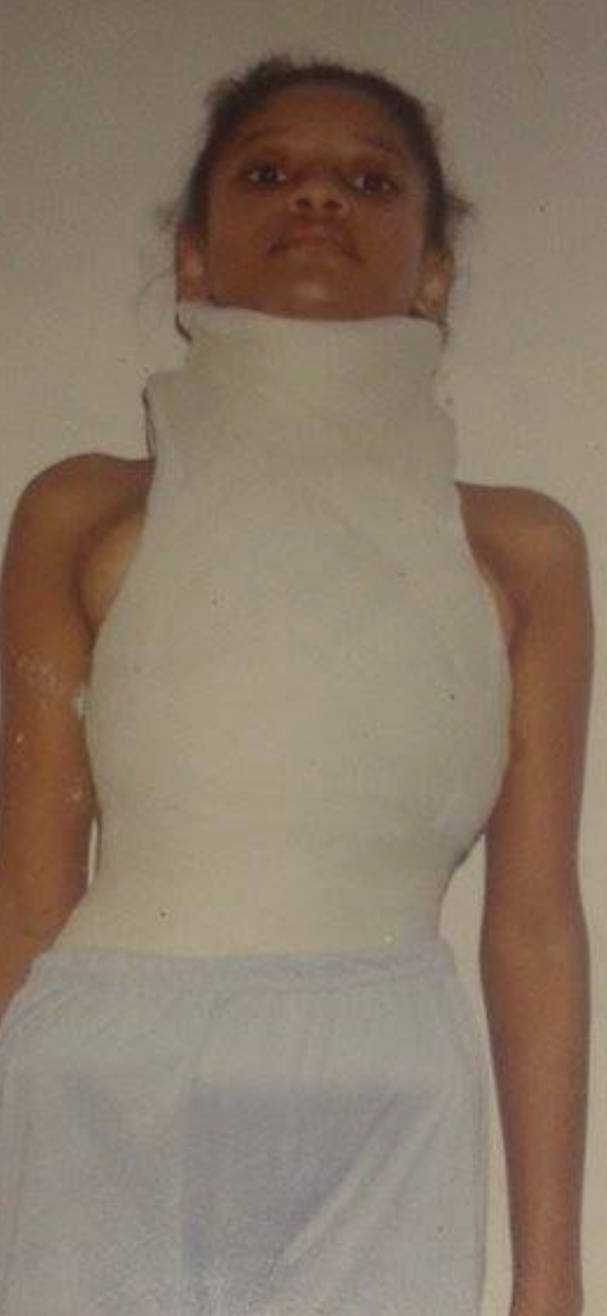 Poor girl in a very high risser cast by chebhasni on DeviantArt