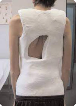 Body cast (rear view)