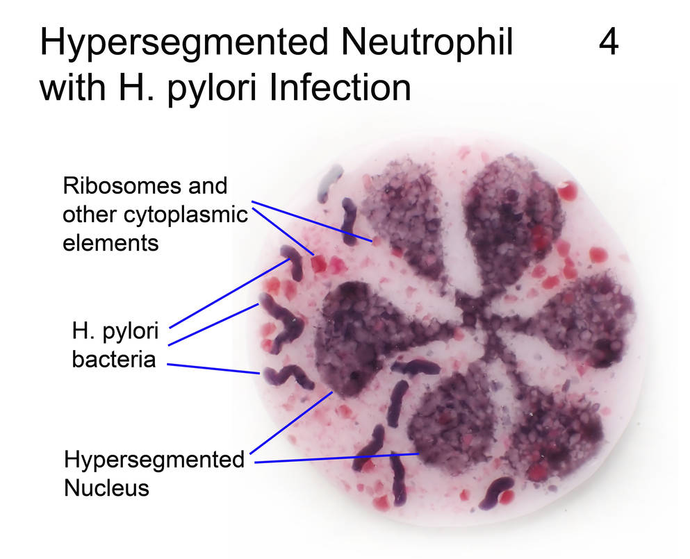 Hypersegmented Neutrophil H pylori infection 4 by trilobiteglassworks ...