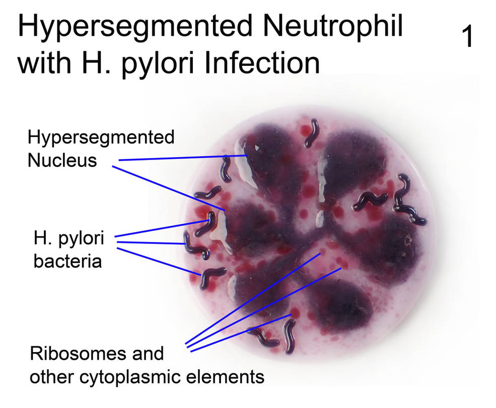 Hypersegment Hypersegmented Neutrophil H pylori infection 1 by trilobiteglassworks ...