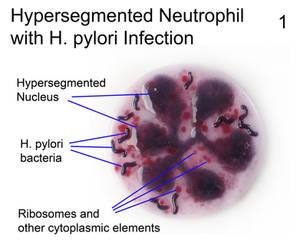 Hypersegmented Neutrophil H pylori infection 1