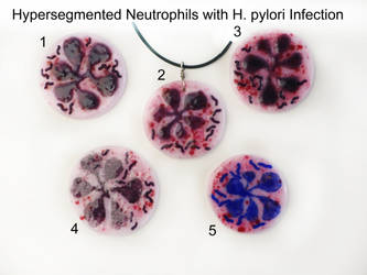 Hypersegmented Neutrophil H pylori infection