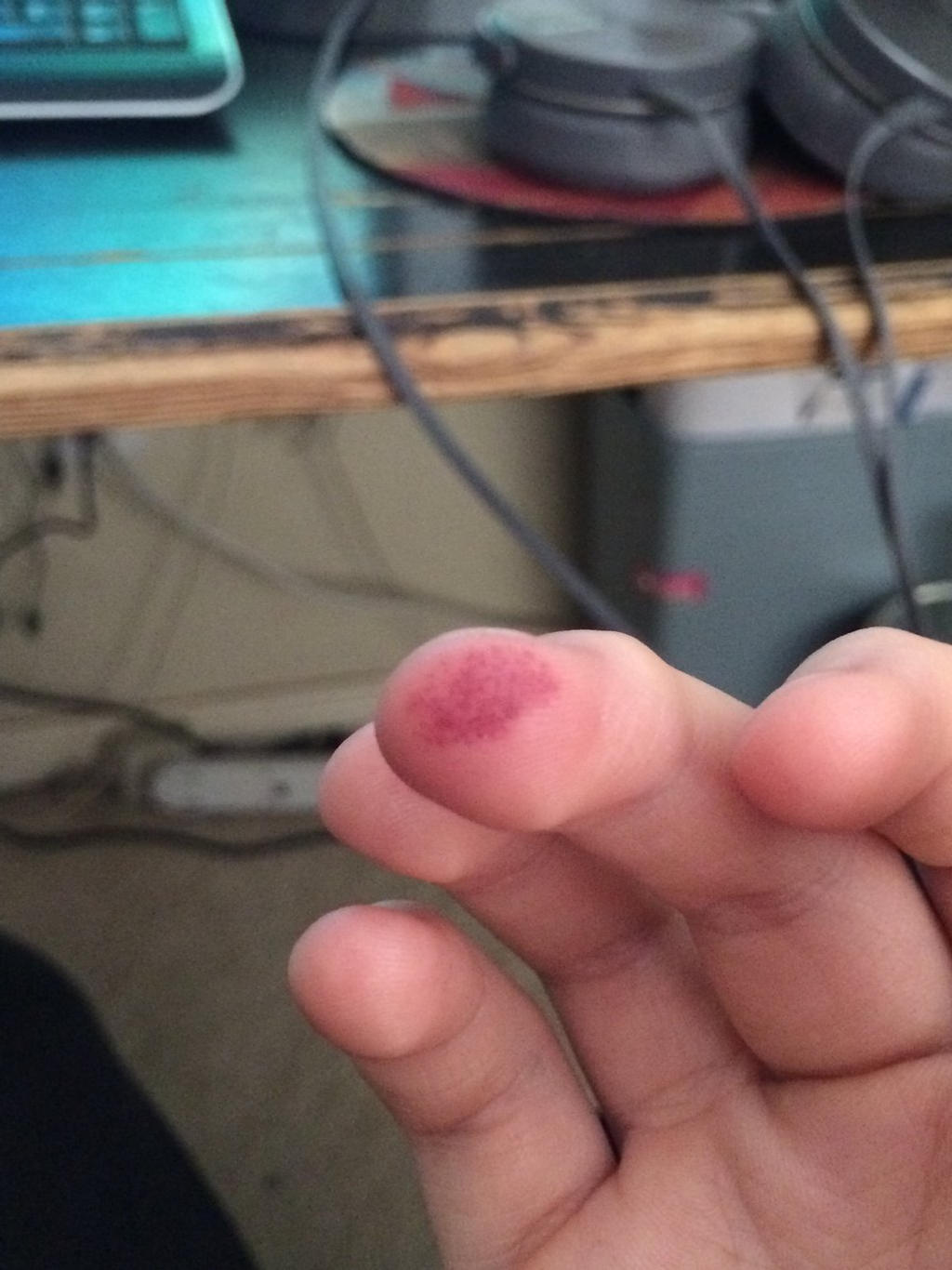 Smashed My Finger Tips In The Door By Lovelybunny 17 On