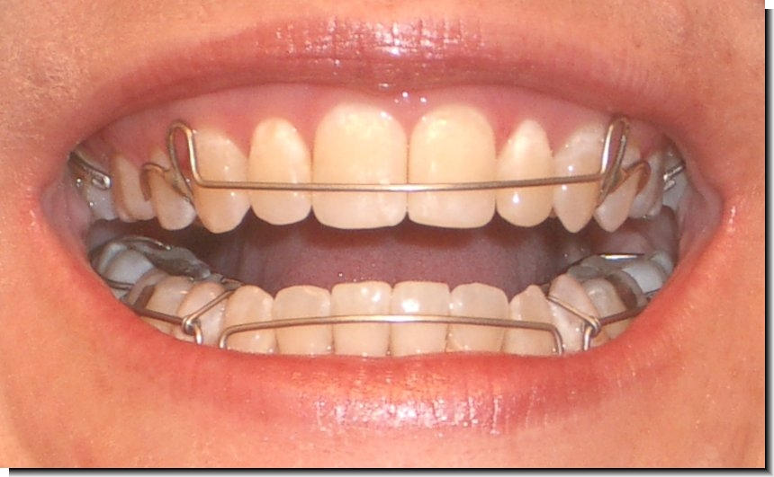 Поставили пластину на зубы. Ретейнеры Хоули. Ортодонтология пластинки брекеты. Скобы пластинки для зубов. Брекеты и пластинки для зубов.
