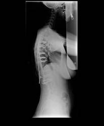 Scoliosis