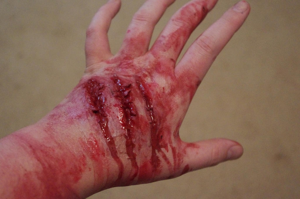 Hand injury