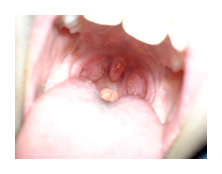 Tonsils