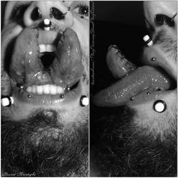 Self tongue split with frenectomy and sutures