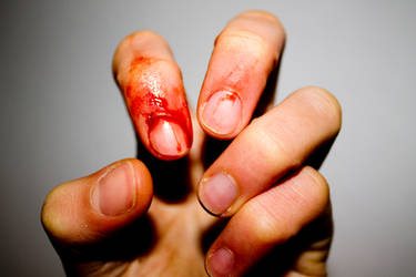 Bleeding finger