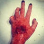 hand injury 4