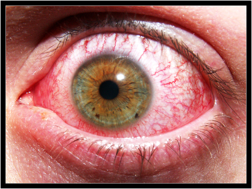 Inflamed Eye