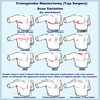 Top Surgery Scars