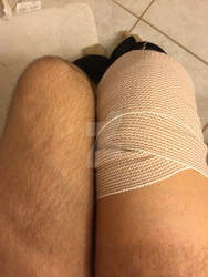 Camparison of legs. Right knee has...