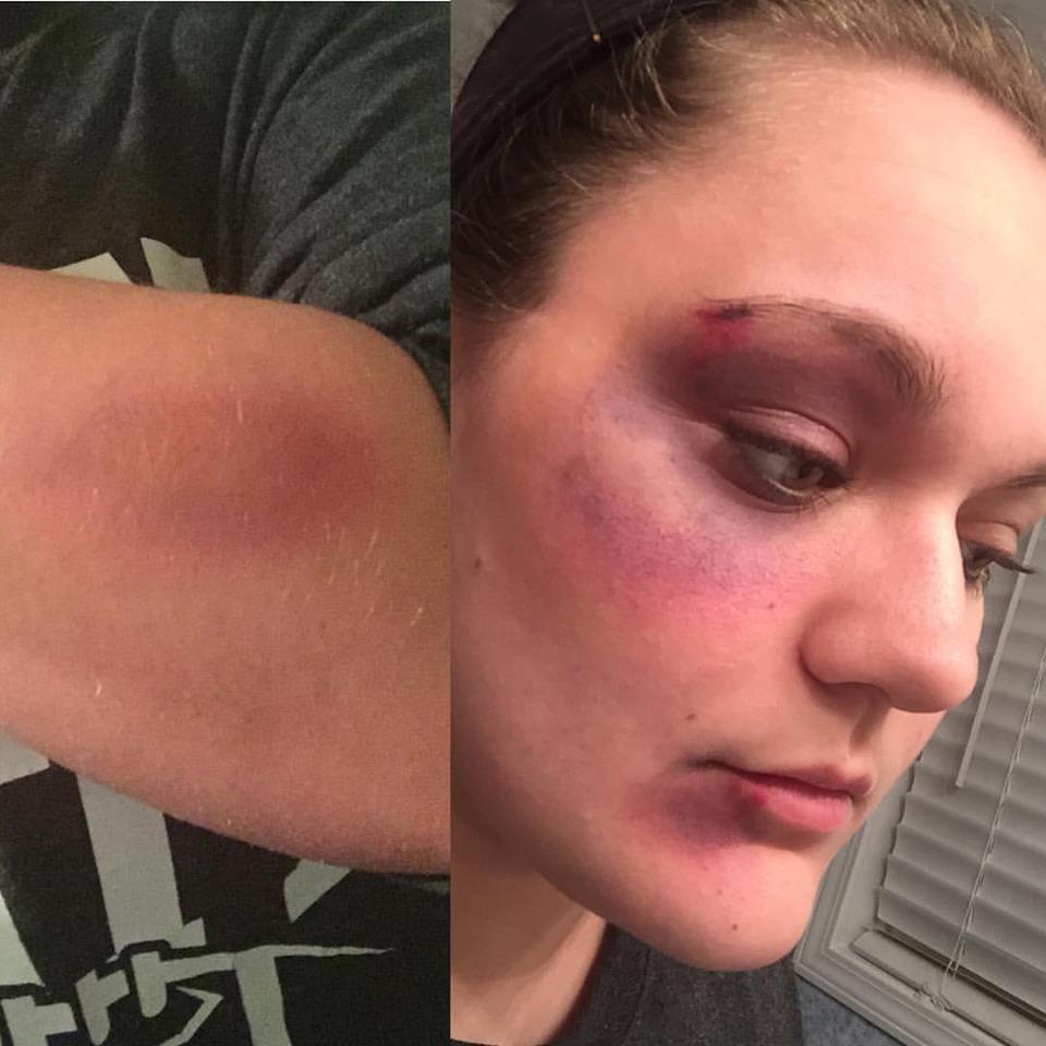 Bruising Makeup Trial Run Part 2