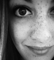 freckle