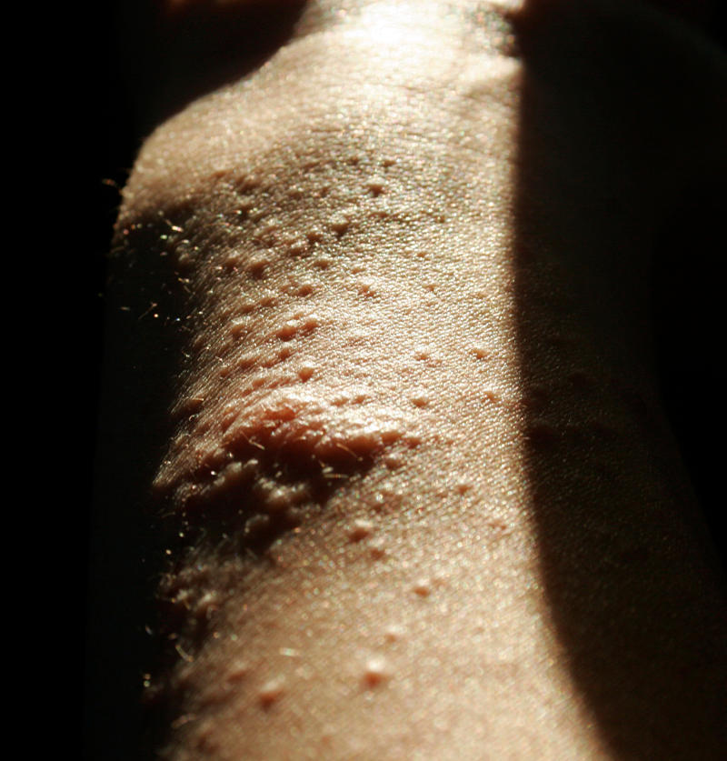 Roble Oak Rash Poison Oak Rash by Superpouf on DeviantArt