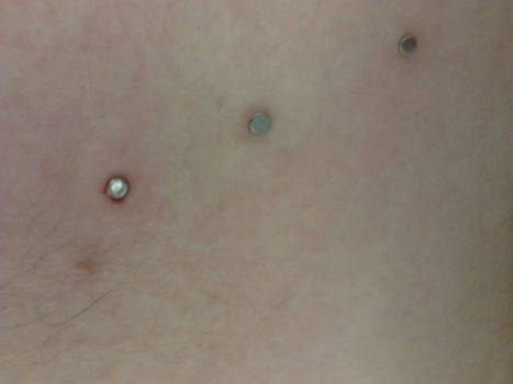 1 micro dermal + 2 skin diver