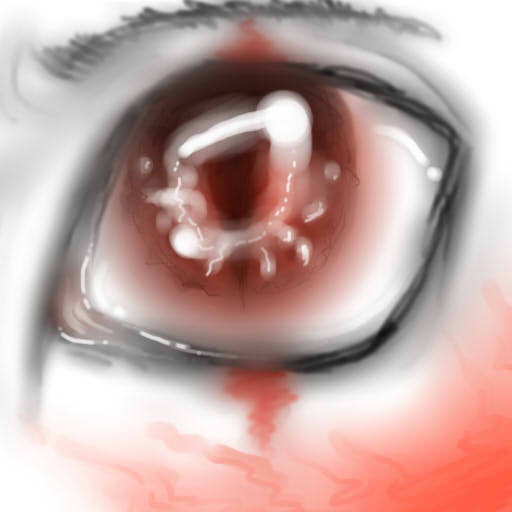 Bleeding eye