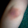 bruised elbow.