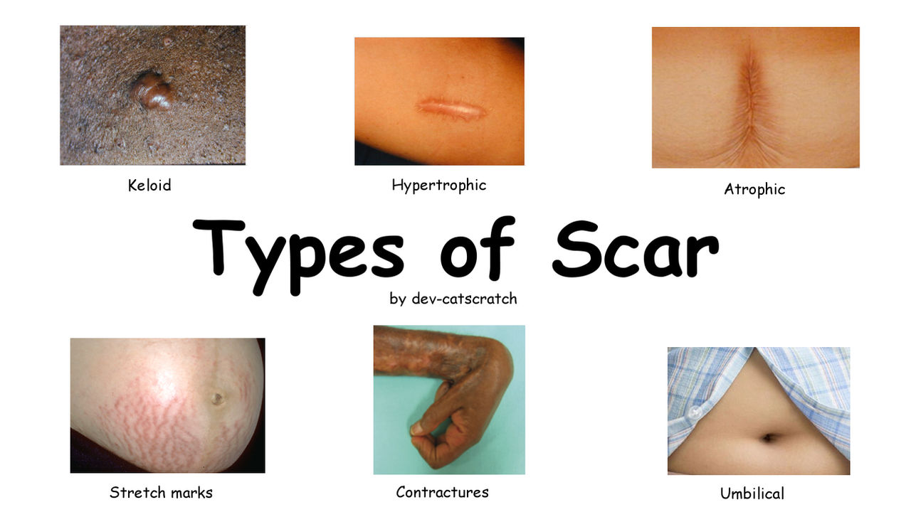 Scar Shape Classification Types of Scar by dev-catscratch on DeviantArt