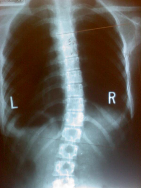 My Spinal Xray. Upper Back