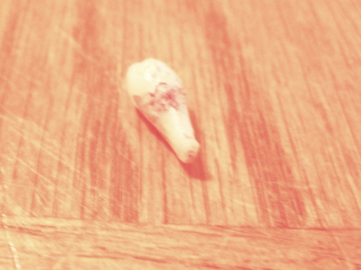 The tooth that caused me so much pain