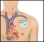 pacemaker by fluidcreativestudio