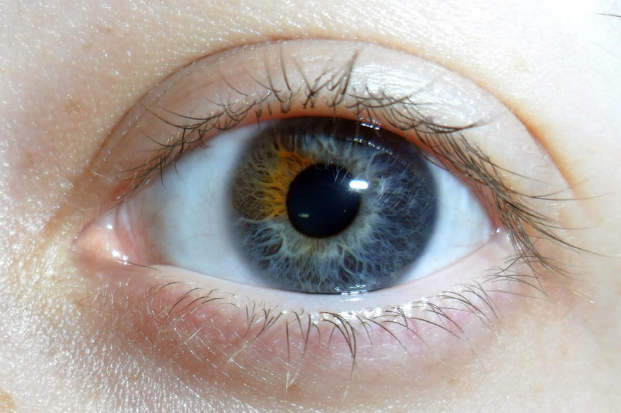 Sectoral Heterochromia