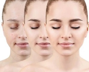 Acne- Scar Treatments