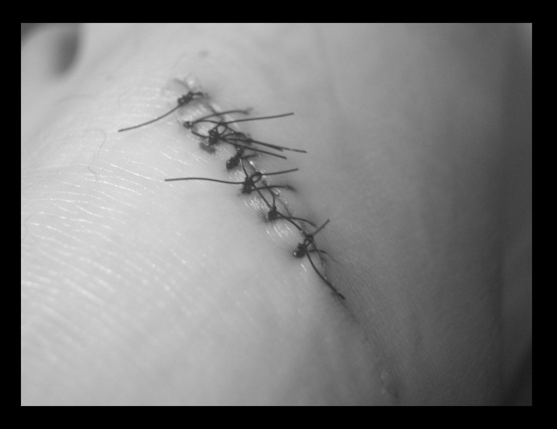 Stitches.