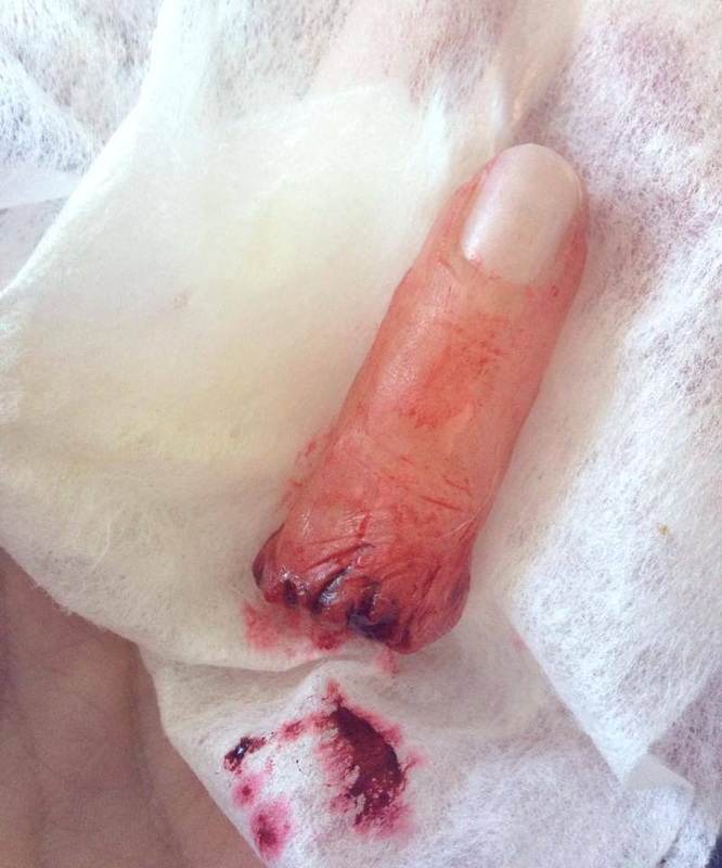 Chopped Finger