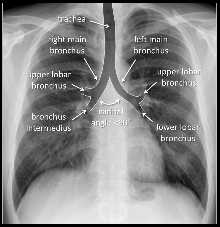 How To Identify Pa View Chest X Ray at Kevin Marsh blog