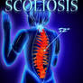 SCOLIOSIS (I have it)