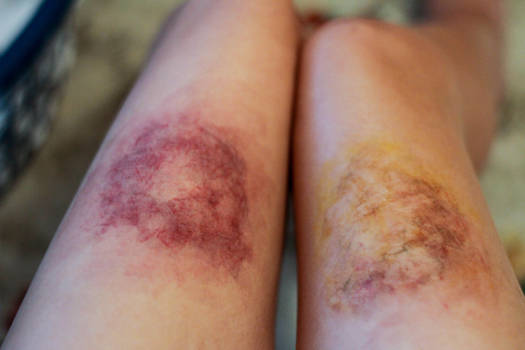 Bruises