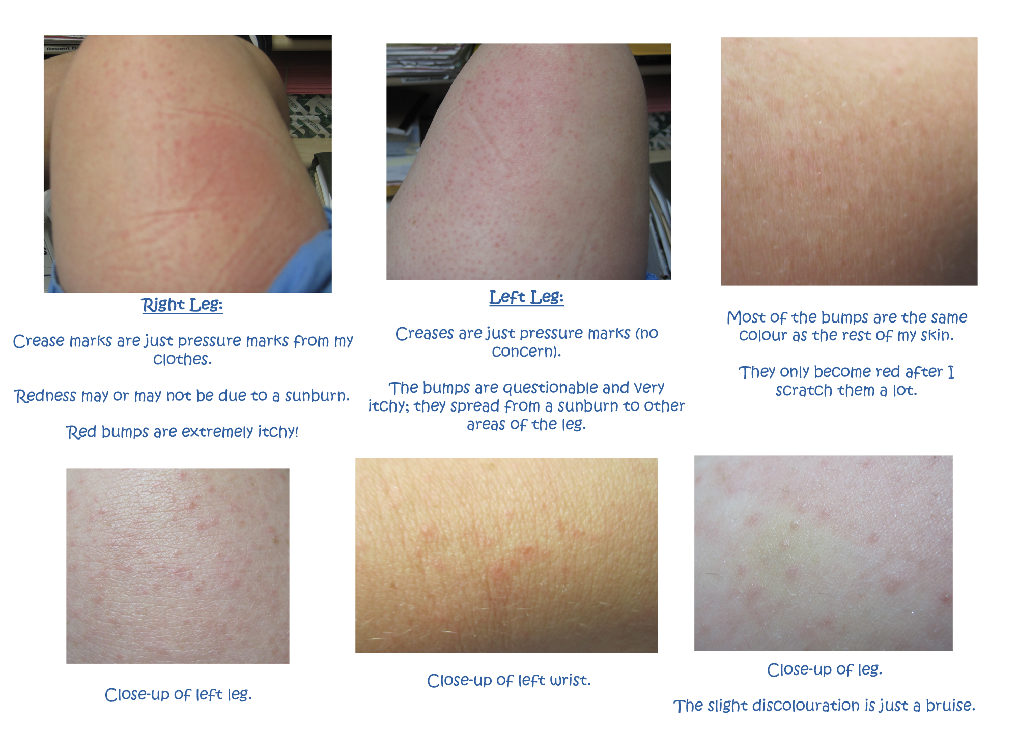 Beginning Lamictal Rash