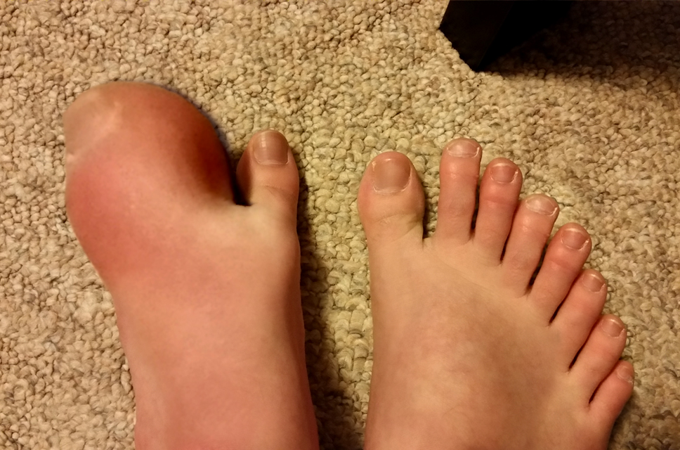10 Toe Foot 10 toes by MrManipulator on DeviantArt