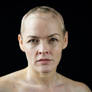 Woman with Alopecia and Vitiligo