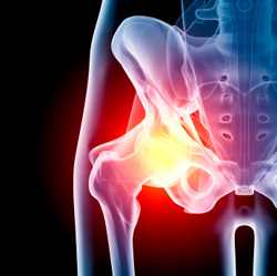 depuy hip recall