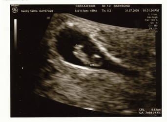 my 7 week baby scan