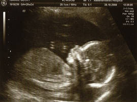 my baby 20 week scan