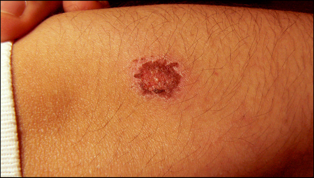 Carpet Burn On Elbow