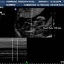 12 week scan FETAL HEART RATE