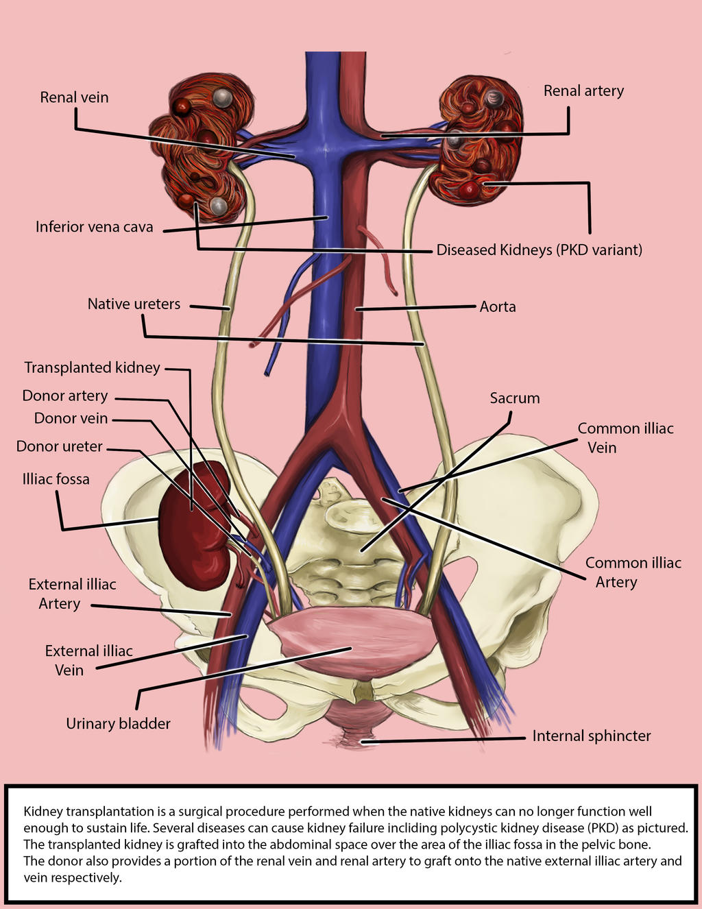 kidney-transplantation-diagram-by-traveling-adventurer-on-deviantart