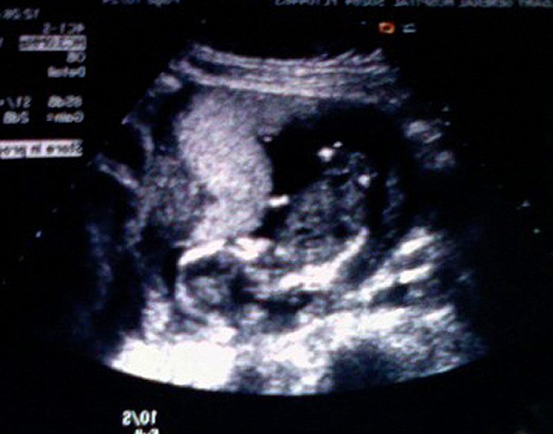 ultrasound 16 weeks